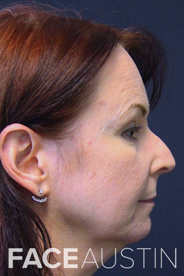 Rhinoplasty Before & After Gallery - Patient 24221123 - Image 1