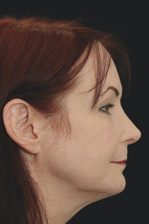 Rhinoplasty Before & After Gallery - Patient 24221123 - Image 4