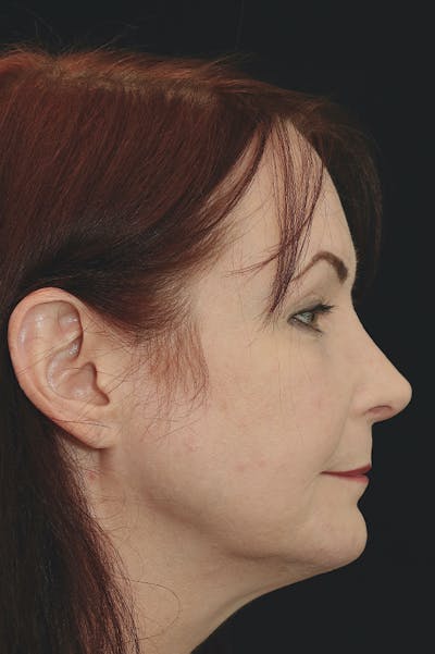 Rhinoplasty Before & After Gallery - Patient 24221123 - Image 4