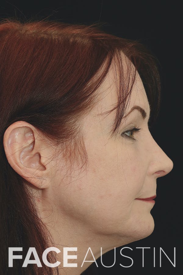 Rhinoplasty Before & After Gallery - Patient 24221123 - Image 4