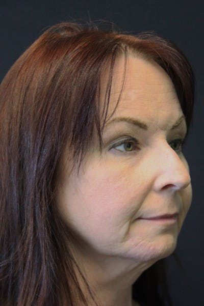 Rhinoplasty Before & After Gallery - Patient 24221123 - Image 1