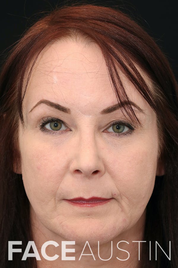 Rhinoplasty Before & After Gallery - Patient 24221123 - Image 6