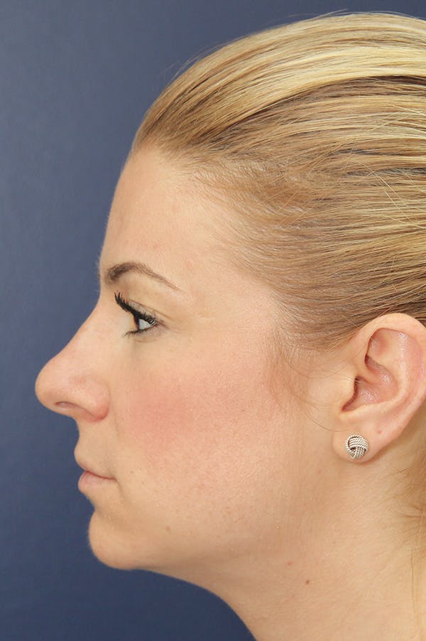Rhinoplasty Before & After Gallery - Patient 24221124 - Image 3