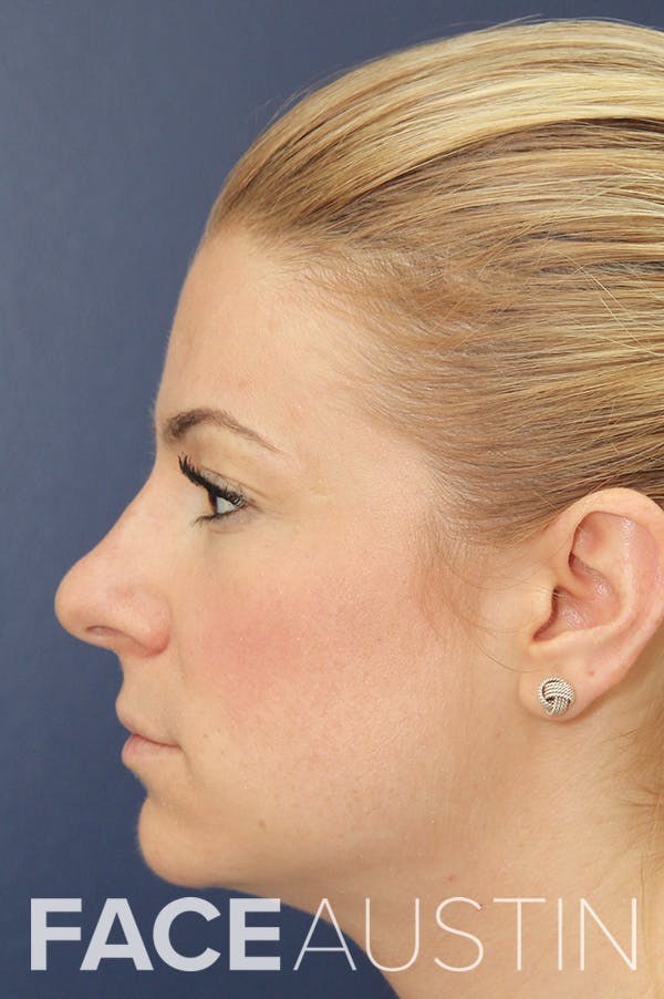 Rhinoplasty Before & After Gallery - Patient 24221124 - Image 1