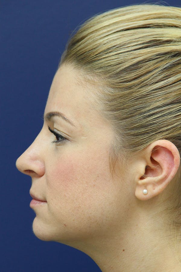 Rhinoplasty Before & After Gallery - Patient 24221124 - Image 4