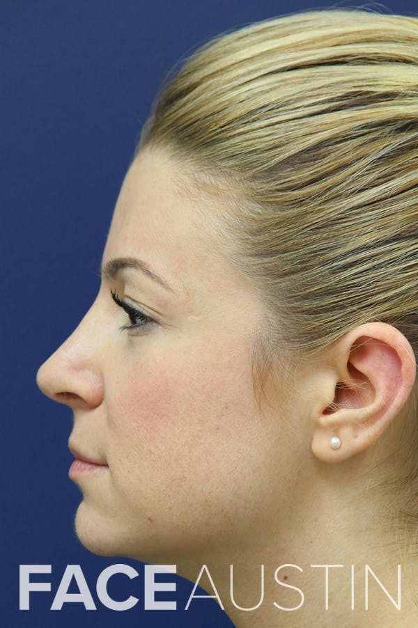 Rhinoplasty Before & After Gallery - Patient 24221124 - Image 4