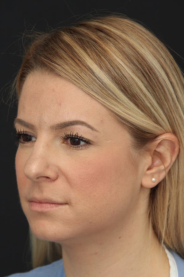 Rhinoplasty Before & After Gallery - Patient 24221124 - Image 1