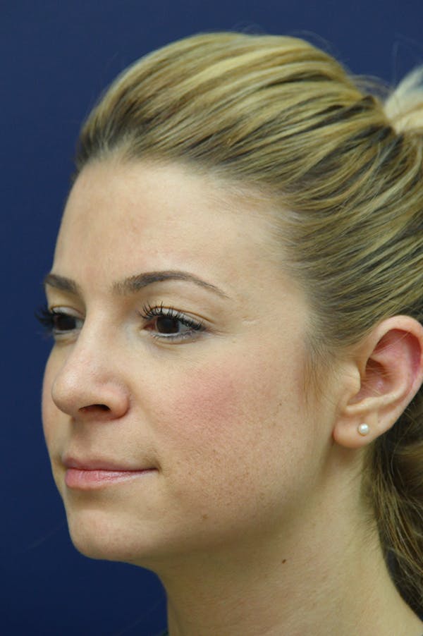 Rhinoplasty Before & After Gallery - Patient 24221124 - Image 4