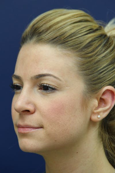 Rhinoplasty Before & After Gallery - Patient 24221124 - Image 2