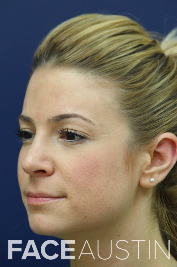 Rhinoplasty Before & After Gallery - Patient 24221124 - Image 2