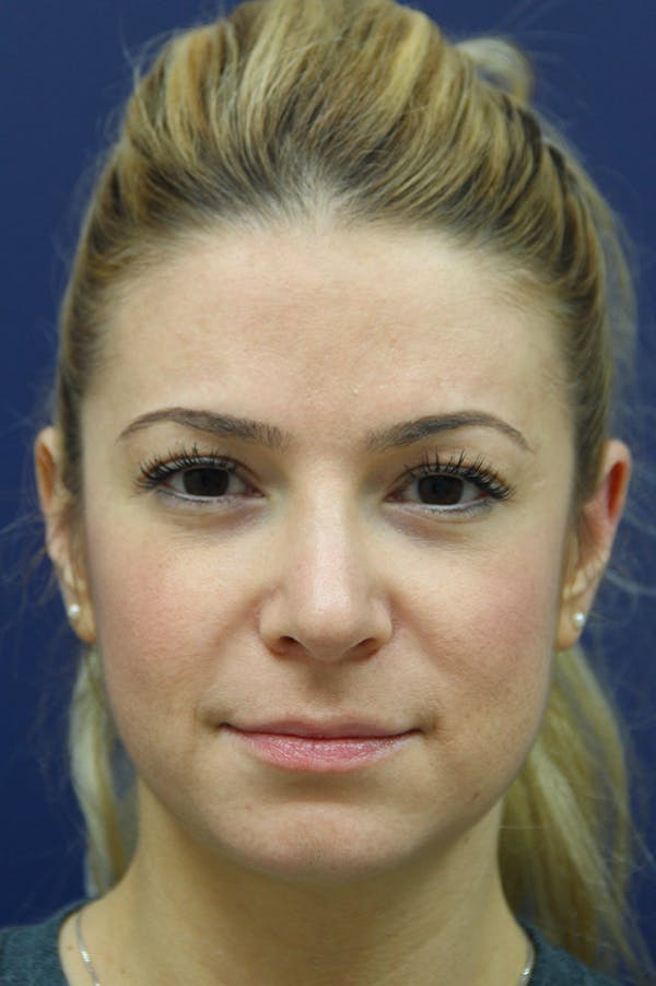 Rhinoplasty Before & After Gallery - Patient 24221124 - Image 6