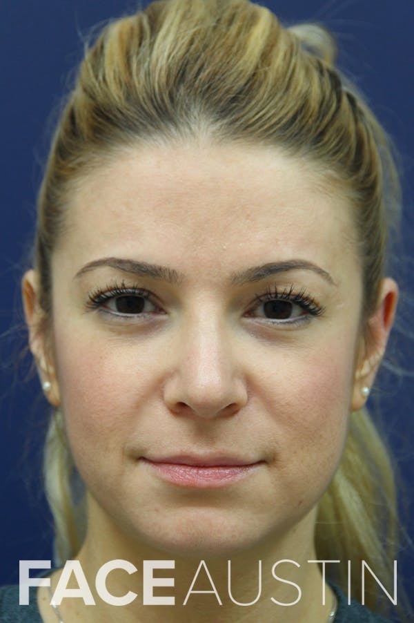 Rhinoplasty Before & After Gallery - Patient 24221124 - Image 6