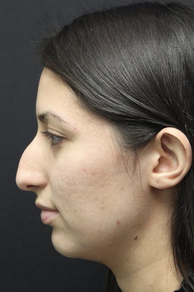Rhinoplasty Before & After Gallery - Patient 24221125 - Image 1