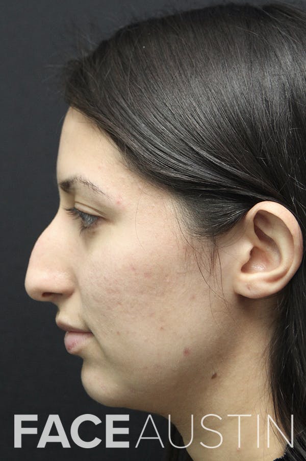 Rhinoplasty Before & After Gallery - Patient 24221125 - Image 1