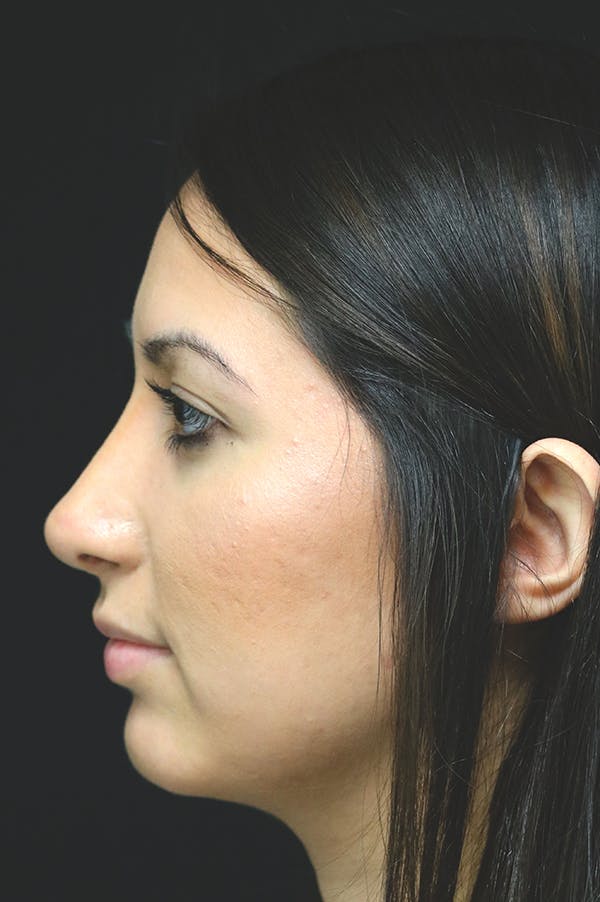Rhinoplasty Before & After Gallery - Patient 24221125 - Image 2