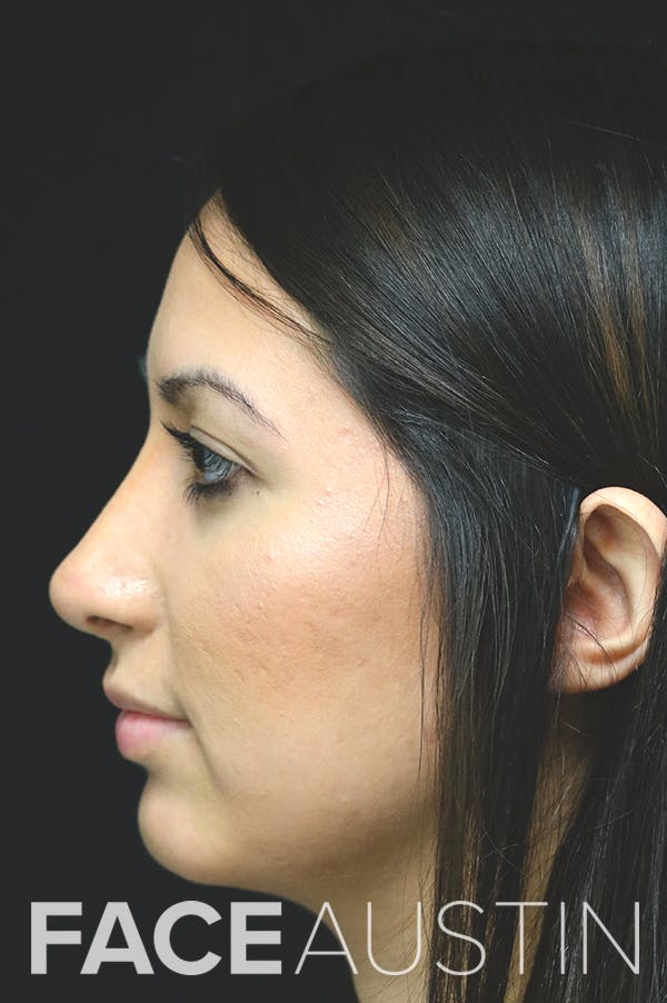 Rhinoplasty Before & After Gallery - Patient 24221125 - Image 2