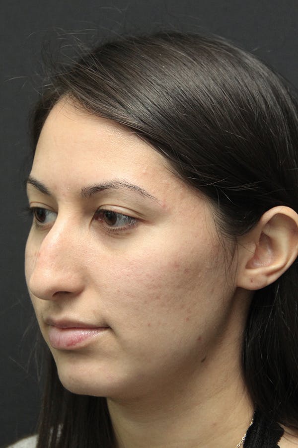 Rhinoplasty Before & After Gallery - Patient 24221125 - Image 3