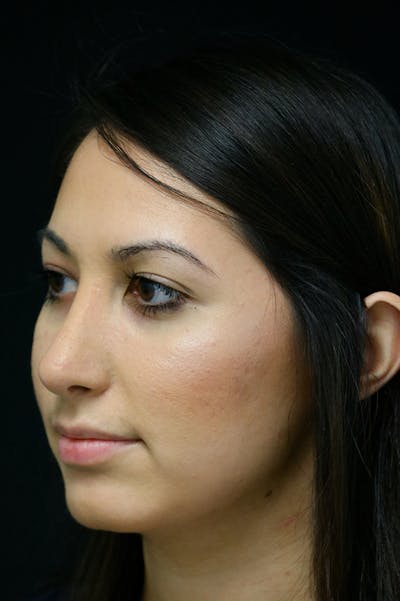 Rhinoplasty Before & After Gallery - Patient 24221125 - Image 4