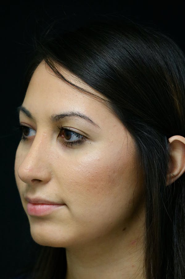 Rhinoplasty Before & After Gallery - Patient 24221125 - Image 4
