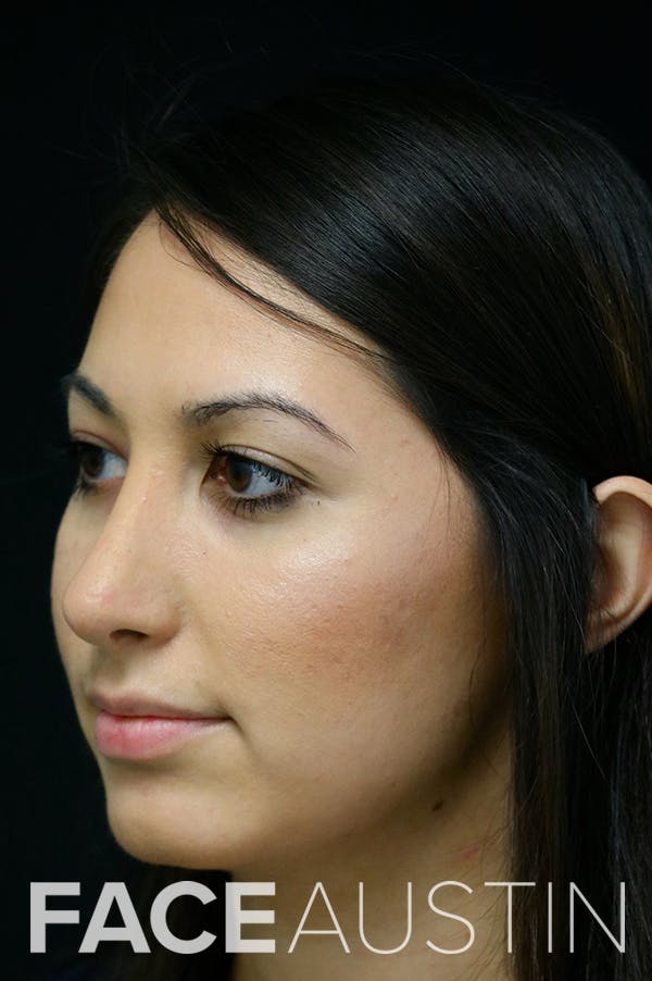 Rhinoplasty Before & After Gallery - Patient 24221125 - Image 4