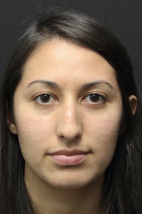 Rhinoplasty Before & After Gallery - Patient 24221125 - Image 5