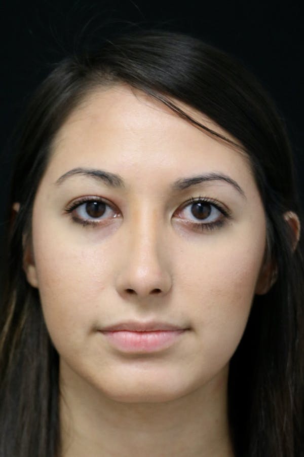 Rhinoplasty Before & After Gallery - Patient 24221125 - Image 6