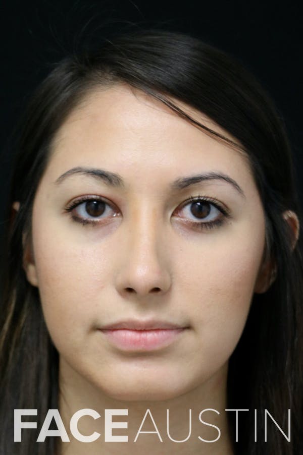 Rhinoplasty Before & After Gallery - Patient 24221125 - Image 6