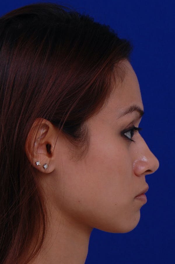 Rhinoplasty Before & After Gallery - Patient 24221126 - Image 1