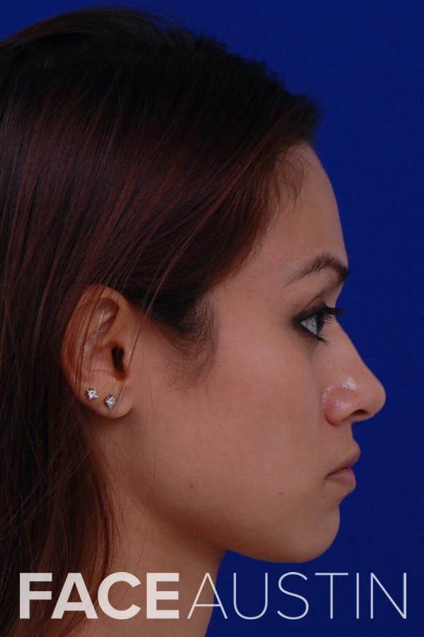 Rhinoplasty Before & After Gallery - Patient 24221126 - Image 1
