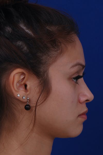 Rhinoplasty Before & After Gallery - Patient 24221126 - Image 2