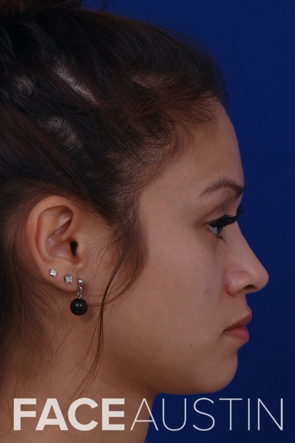 Rhinoplasty Before & After Gallery - Patient 24221126 - Image 2