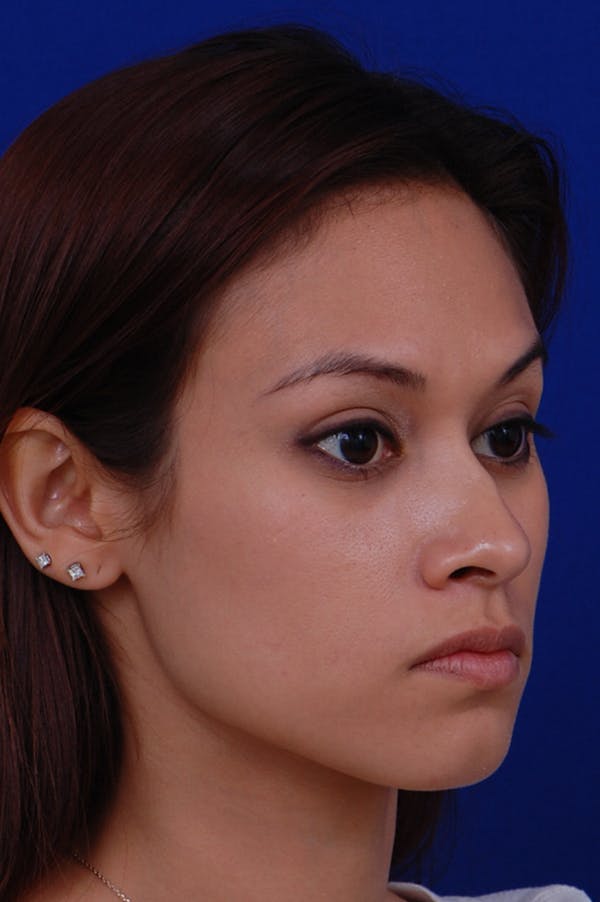 Rhinoplasty Before & After Gallery - Patient 24221126 - Image 3