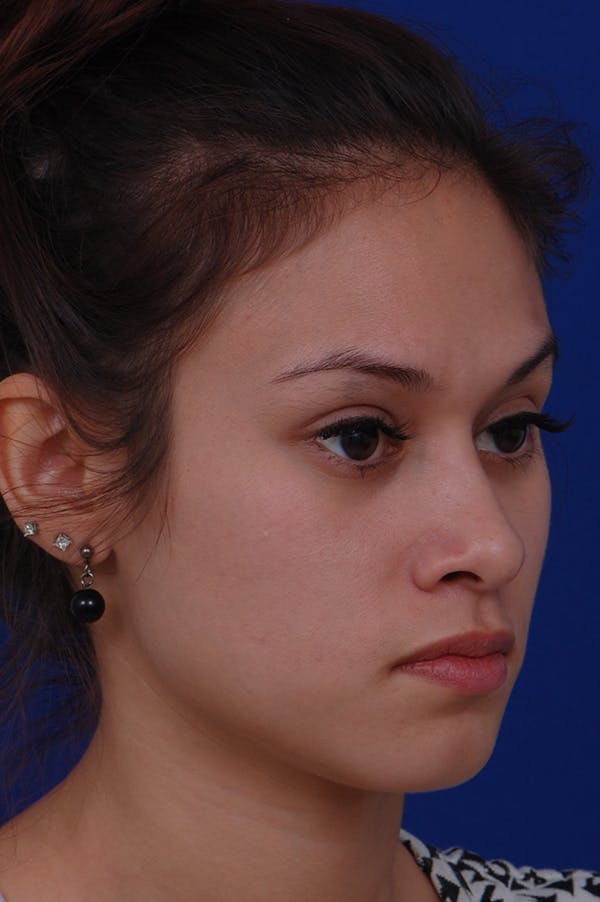 Rhinoplasty Before & After Gallery - Patient 24221126 - Image 4