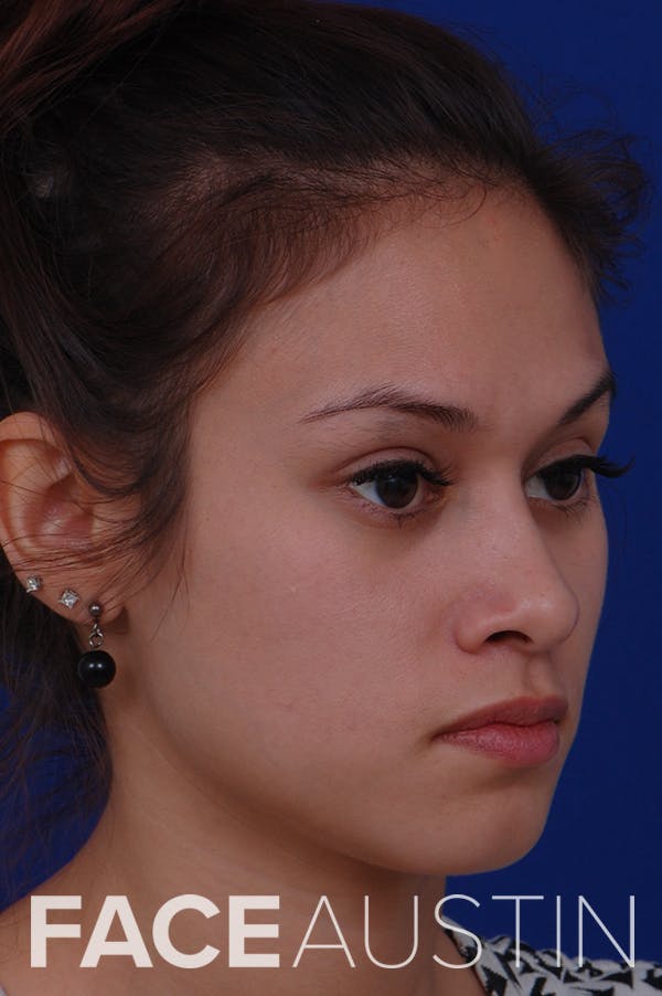 Rhinoplasty Before & After Gallery - Patient 24221126 - Image 4