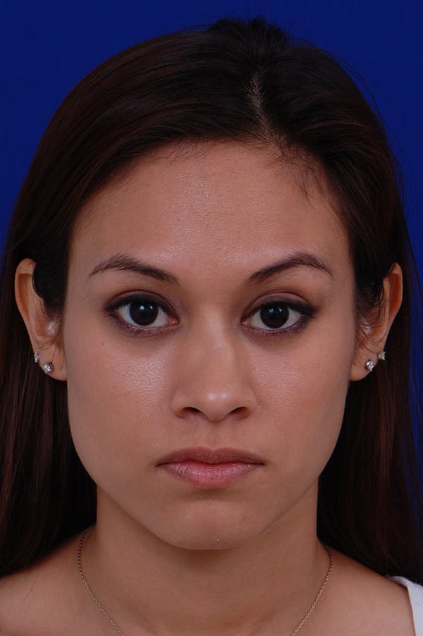 Rhinoplasty Before & After Gallery - Patient 24221126 - Image 5