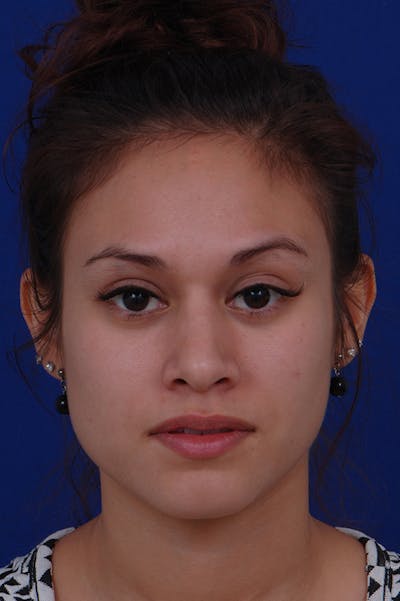 Rhinoplasty Before & After Gallery - Patient 24221126 - Image 6