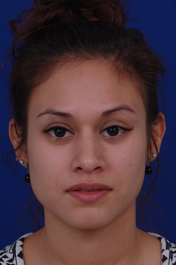Rhinoplasty Before & After Gallery - Patient 24221126 - Image 6