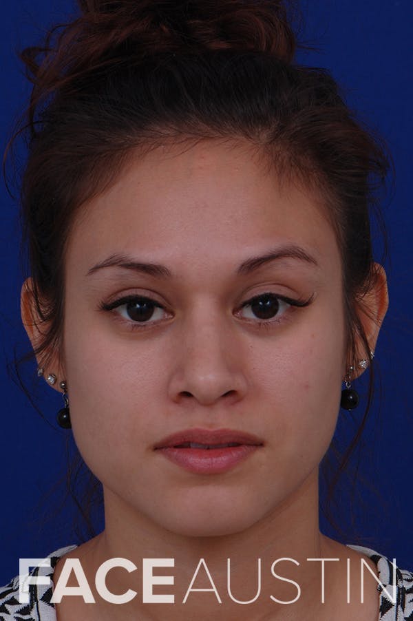 Rhinoplasty Before & After Gallery - Patient 24221126 - Image 6