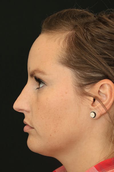 Rhinoplasty Before & After Gallery - Patient 24221127 - Image 1