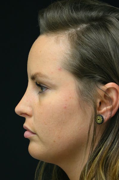 Rhinoplasty Before & After Gallery - Patient 24221127 - Image 2