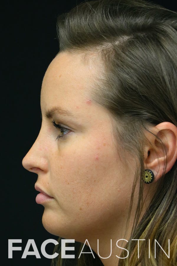 Rhinoplasty Before & After Gallery - Patient 24221127 - Image 2