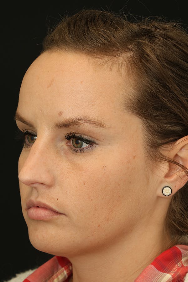Rhinoplasty Before & After Gallery - Patient 24221127 - Image 3