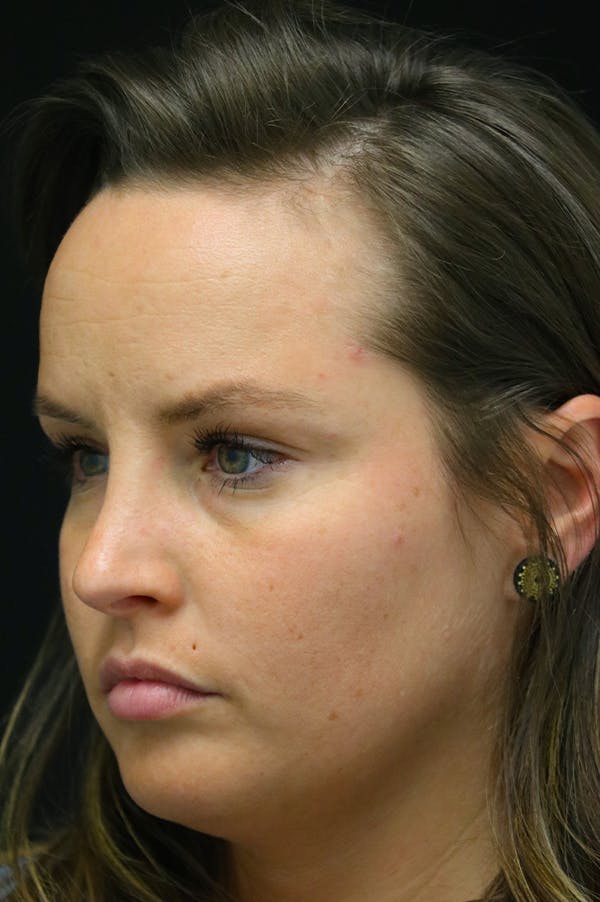 Rhinoplasty Before & After Gallery - Patient 24221127 - Image 4