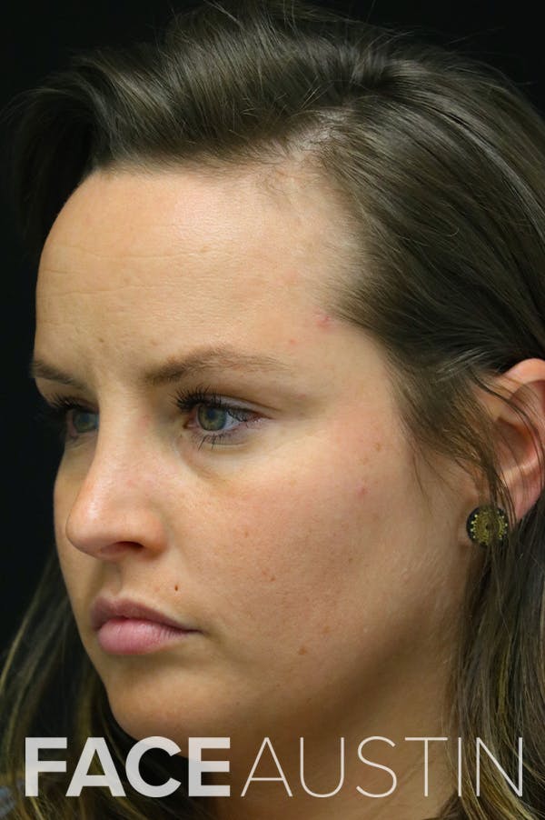 Rhinoplasty Before & After Gallery - Patient 24221127 - Image 4