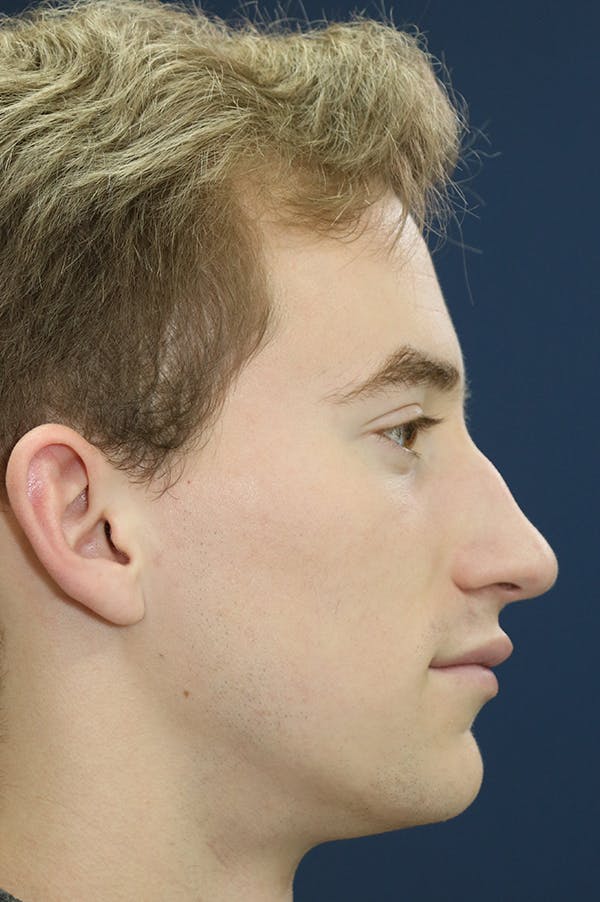 Rhinoplasty Before & After Gallery - Patient 24221128 - Image 1