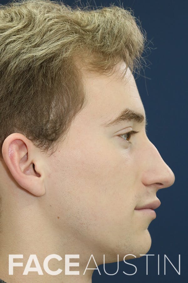 Rhinoplasty Before & After Gallery - Patient 24221128 - Image 1