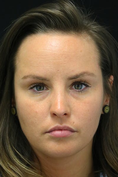 Rhinoplasty Before & After Gallery - Patient 24221127 - Image 6