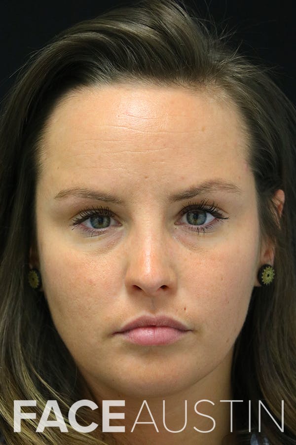 Rhinoplasty Before & After Gallery - Patient 24221127 - Image 6