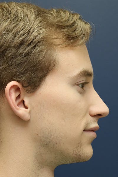 Rhinoplasty Before & After Gallery - Patient 24221128 - Image 2