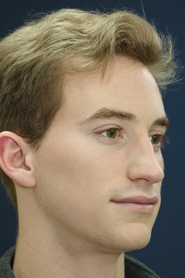 Rhinoplasty Before & After Gallery - Patient 24221128 - Image 3